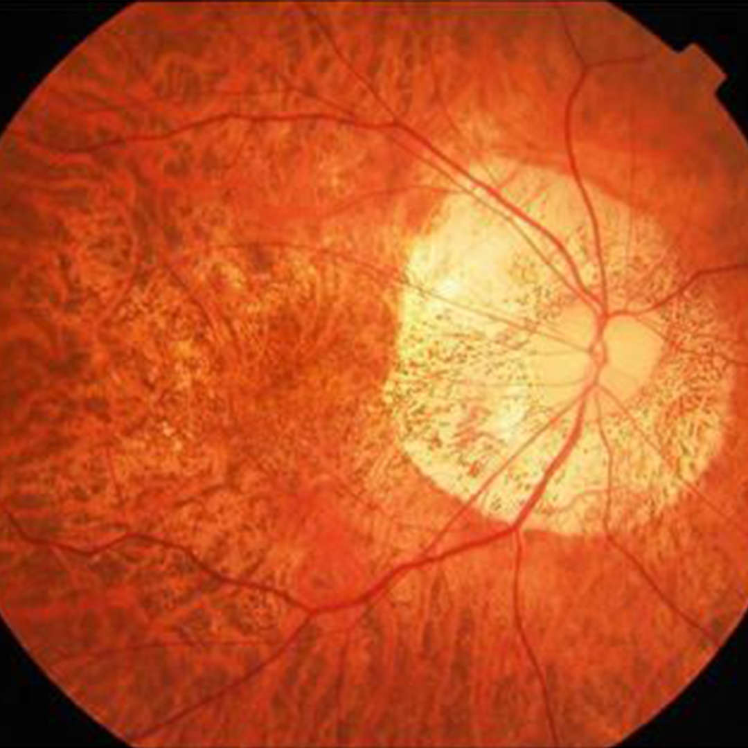 What is Myopia?